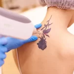 Tattoo Removal for a Clean Slate