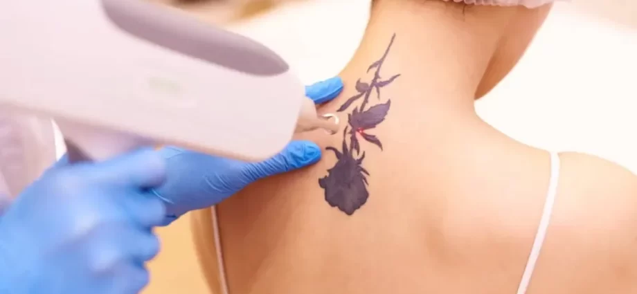 Tattoo Removal for a Clean Slate